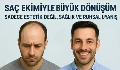 Saç Ekimi Nedir? Türkiye’de Saç Ekimi: Sadece Görsellik Değil, Sağlık ve Ruhsal Dönüşümün Anahtarı 2025
